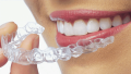 Aligners Globe